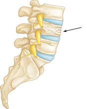 File:Afb osteo 1.png
