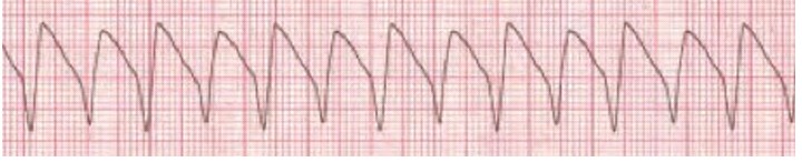 File:Ventricilular tachycardia.jpg