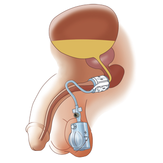 File:Artificial Urinary Sphincter.png