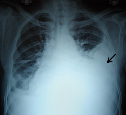 Massive right-sided pleural effusion later shown to be a hemothorax