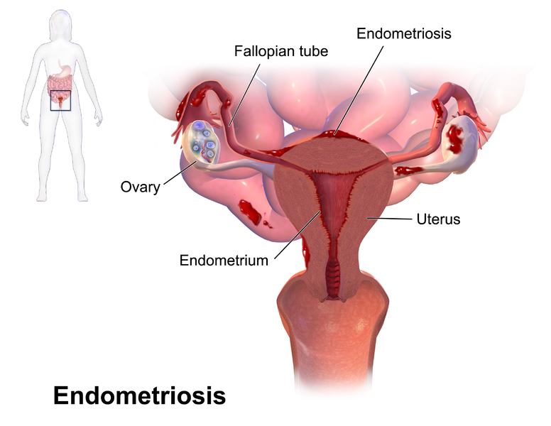 File:Endometriosis.png
