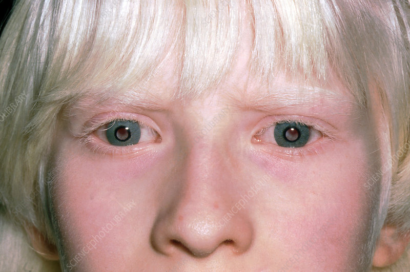 File:Eyes albinism 1.jpeg