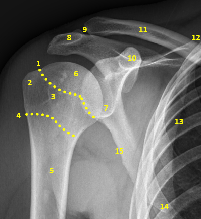 File:Shoulder-annotated-x-rays-2.jpeg