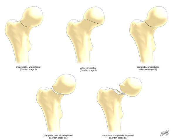 File:Garden-classification-of-hip-fractures-diagram.jpeg