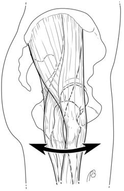 File:Snapping hip lateral.jpg