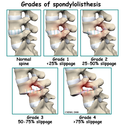 File:Lumbar spondylolisthesis grades.jpg