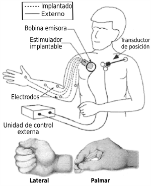 Neuroprosthesis.png