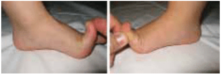 Dorsiflexion of big toe.png