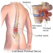 File:Low back pinched nerve.jpg