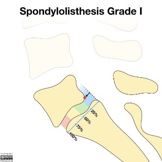 spondylolisthesis rehab protocol