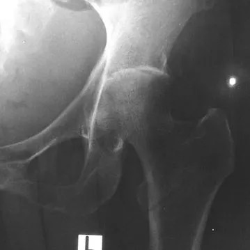 File:Septic arthritis of left hip joint with melioidosis.jpg
