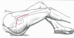 Posterior hip approach illustration