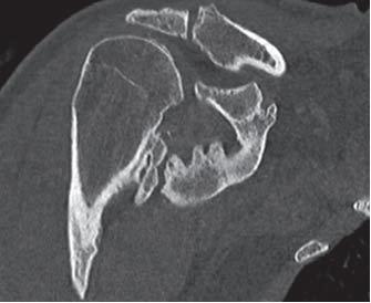 'Figure.4 CT Scan showing Heterotopic Ossification of the Shoulder