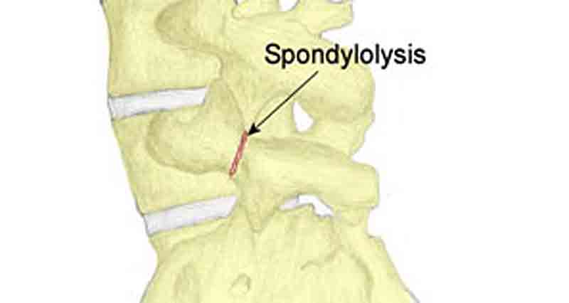 File:Spondylolysis fracture.jpg