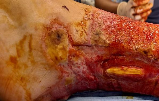 File:Subcutaneous burn tendon.jpeg