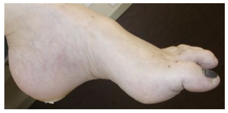 File:Hammer toe, provided by Diane Merwarth PT.png