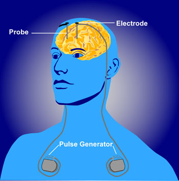 https://www.physio-pedia.com/images/6/63/Deep_brain_stimulation.jpeg