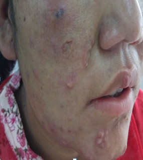 File:Erythematous papules seen in the face of patient with lepromatous leprosy .PNG