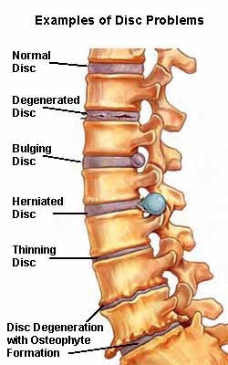 lumbosacralis osteoarthritis hátfájás közvetlenül a lapockák alatt