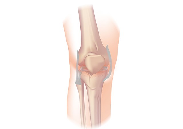 File:Knee osteoarthritis image.jpg