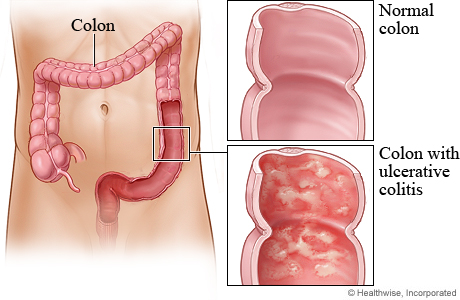 File:Ulcerative Colitis.jpg