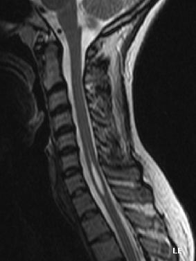 On the right side of this picture we can see how the Syrinx has taken place in the spinal cord