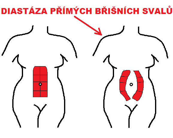 File:Diastasis recti pregnancy.png