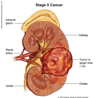 Kidneycancerstage2b.jpg