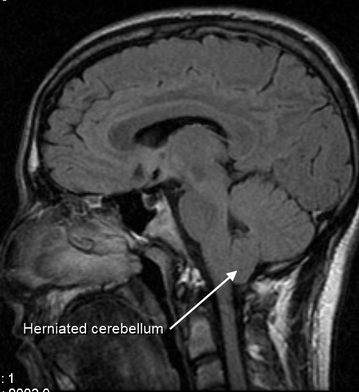 File:MRI of human brain with type-1 Arnold-Chiari malformation and herniated cerebellum.jpg