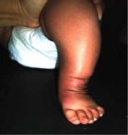 File:Case Study- Idiopathic Unilateral Clubfoot 3.png