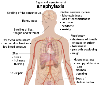 File:Signs and symptoms of anaphylaxis.png