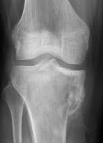 File:Osteo sarcoma Of proximal tibia.jpg