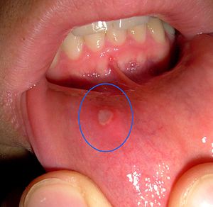 File:Oral Ulcers.jpg