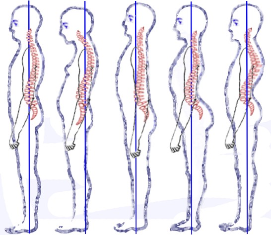 File:Posture types (vertebral column).jpg