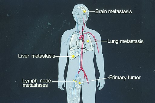 File:Sites of potential metastases illustration.jpeg
