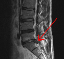Sagital view of L5/S1 HNP on MRI