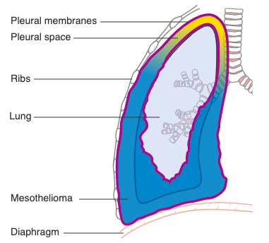 File:Mesotheliomia pm.png