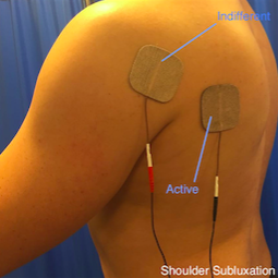 File:Shoulder Subluxation Picture.png