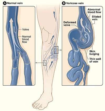 Varicose veins - Causes - NHS