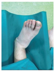 a) Forceful plantar flexion of the fore foot with axial thrust