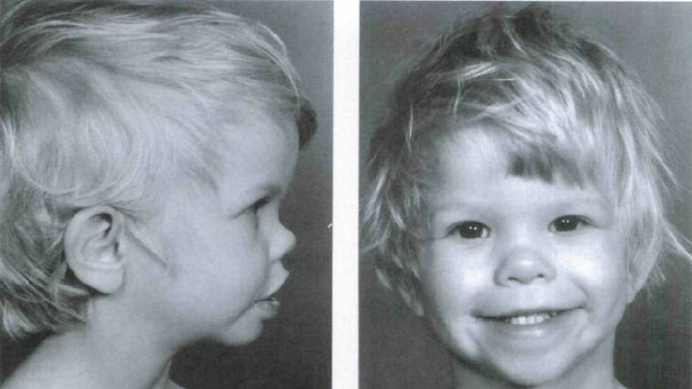 Common facial characteristics of a child with William's Syndrome