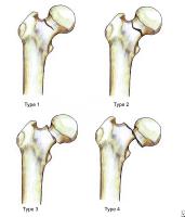 fractura colli femoris puls în articulații în genunchi