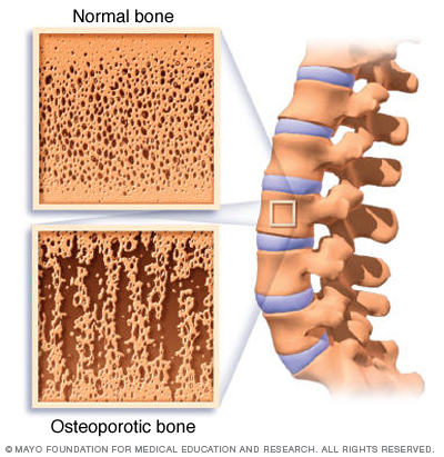Mcdc7 osteoporosis compare.jpg