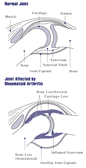 Diagram showing how Rheumatoid Arthritis affects a joint in the hand