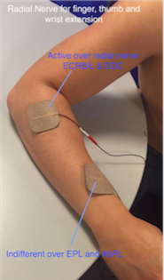Position of the electrical muscle stimulation electrodes placed over