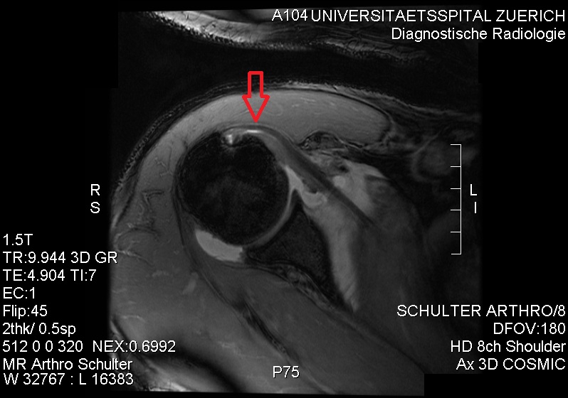 File:MRI. Partial rupture of the cranial subscapularis tendon at the insertion site..jpg