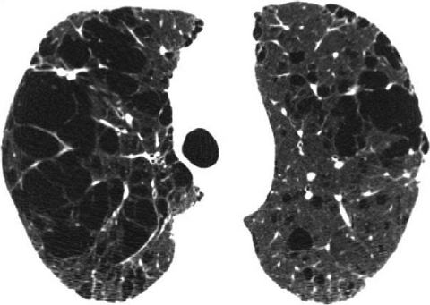 File:Figure-6-Advanced-destructive-emphysema-CT-scan-in-patient-with-GOLD-stage-I-COPD.png