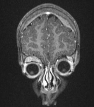 File:Neuroblastoma mets.jpg