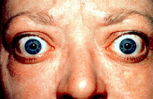 File:Proptosis and lid retraction from Graves' Disease.jpeg
