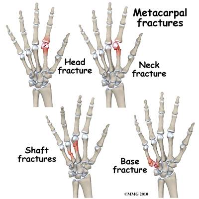 File:Types of metacarpal fractures.jpg